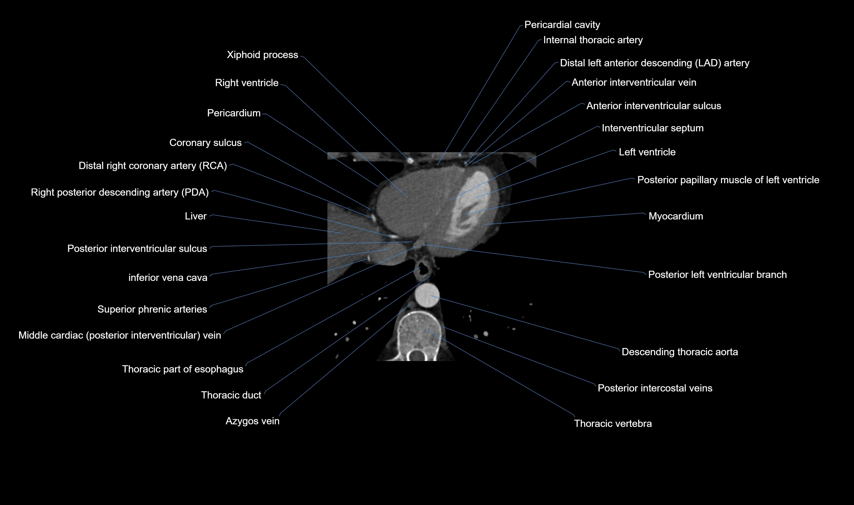CT heart (coronary angiogram) axial view cross sectional anatomy labelled radiology image-00059.webp